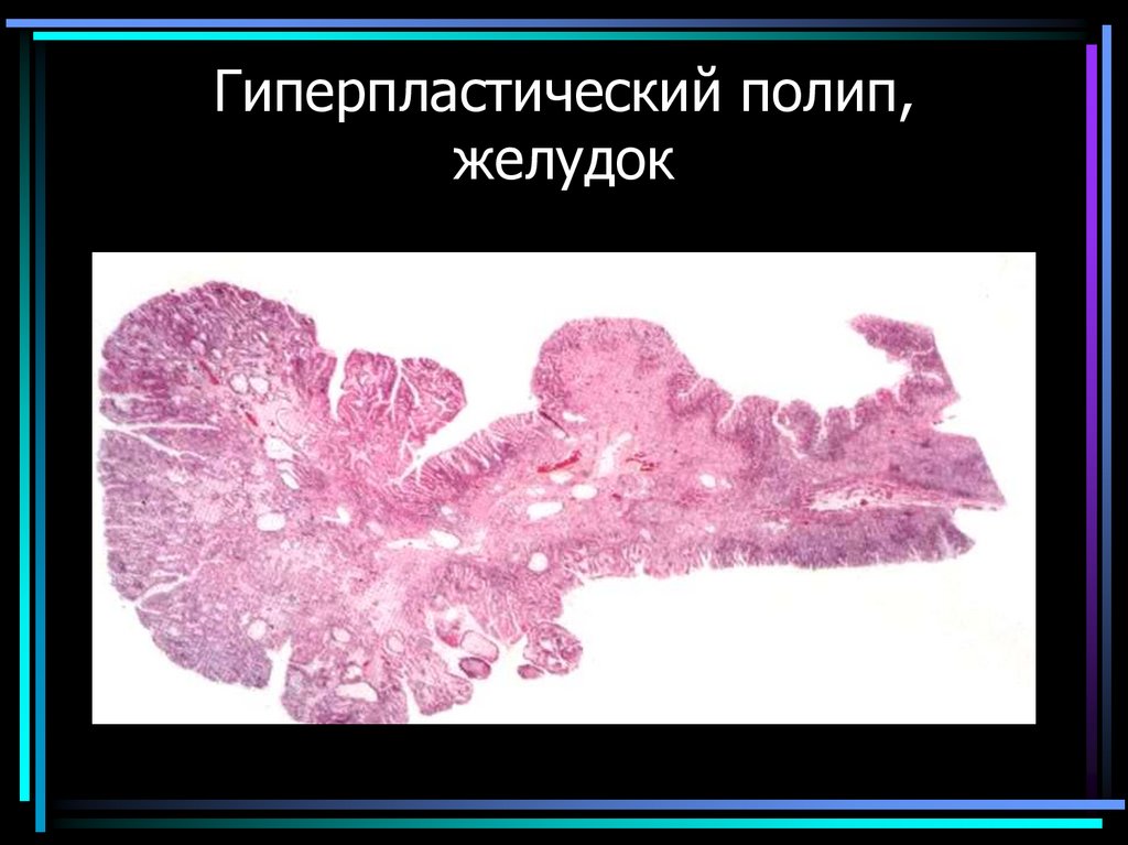 Гиперпластический полип, желудок