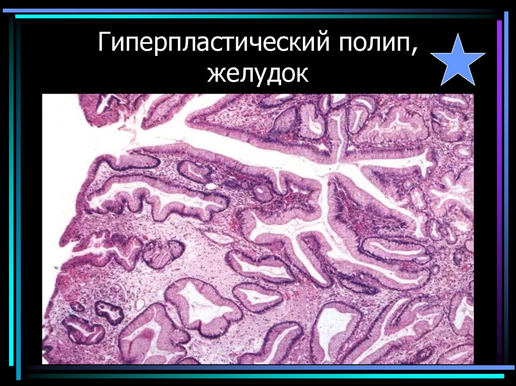 Гиперпластический полип, желудок