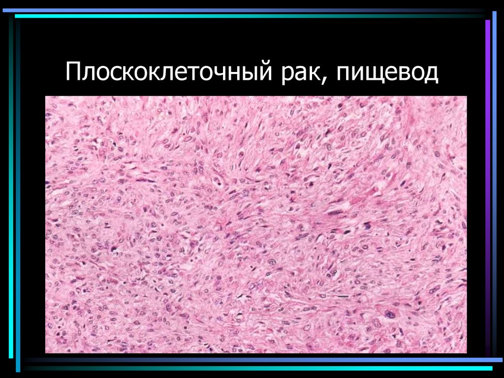 Плоскоклеточный рак, пищевод