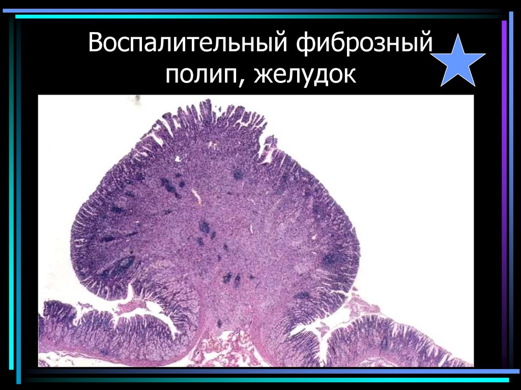 Воспалительный фиброзный полип, желудок