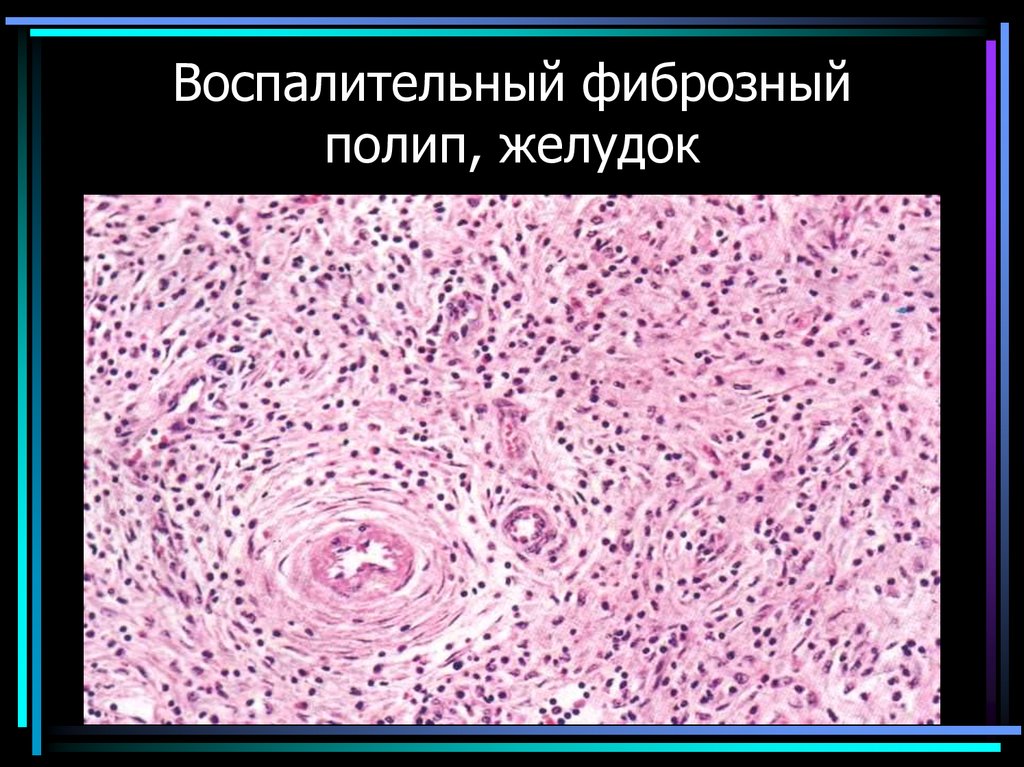 Воспалительный фиброзный полип, желудок