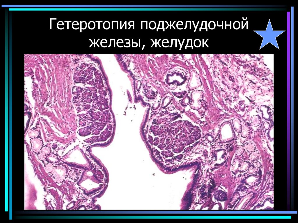 Гетеротопия поджелудочной железы, желудок