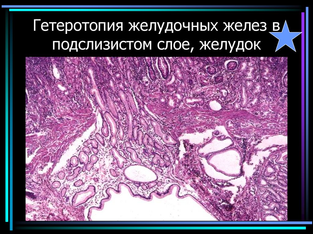 Гетеротопия желудочных желез в подслизистом слое, желудок