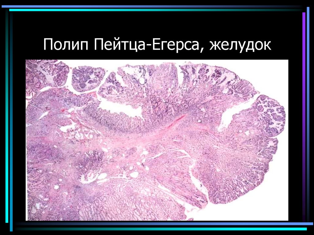 Полип Пейтца-Егерса, желудок