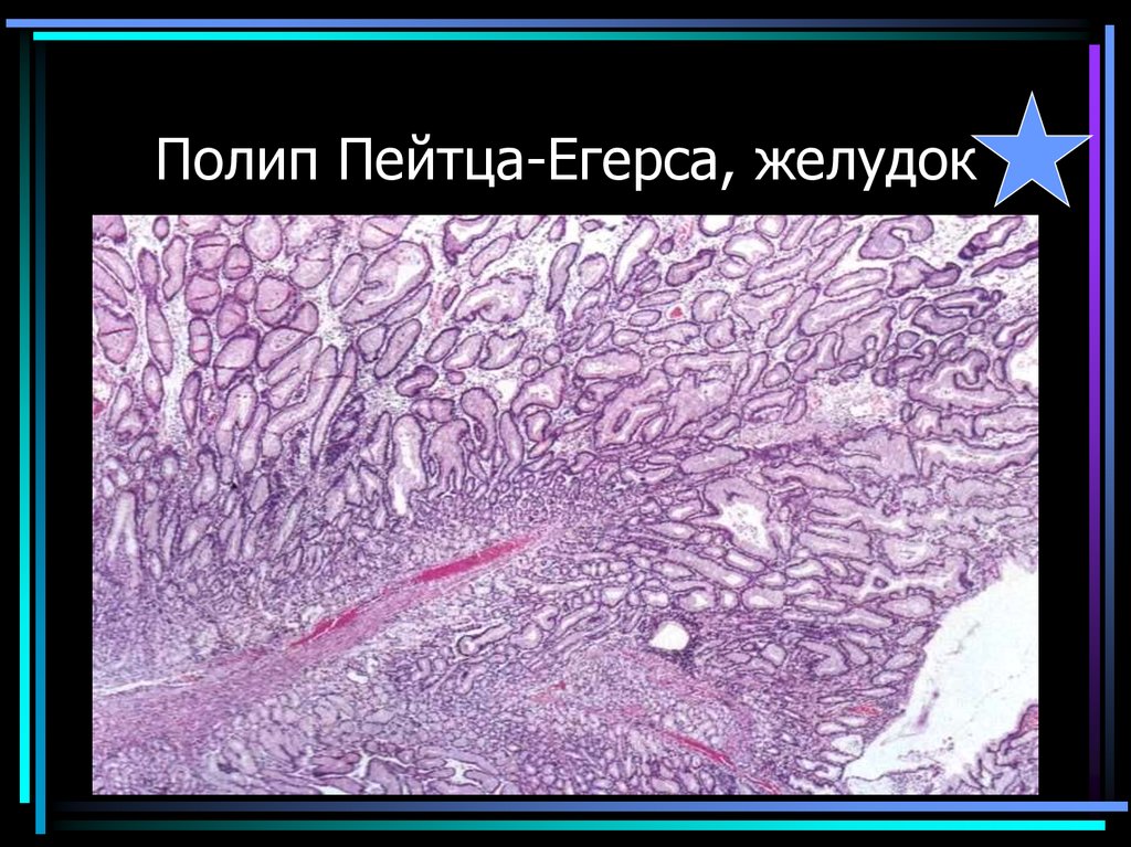 Полип Пейтца-Егерса, желудок