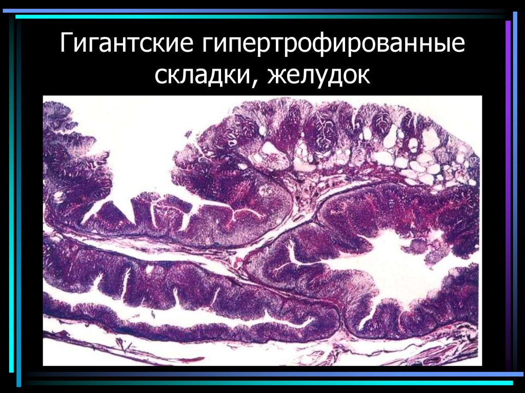 Гигантские гипертрофированные складки, желудок