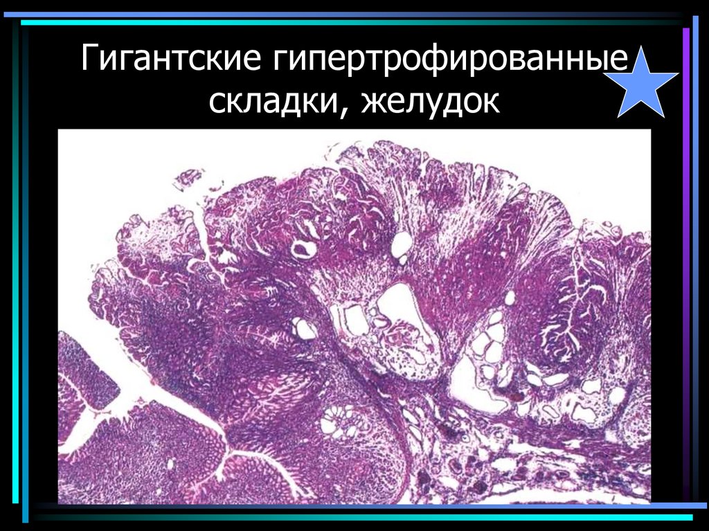 Гигантские гипертрофированные складки, желудок