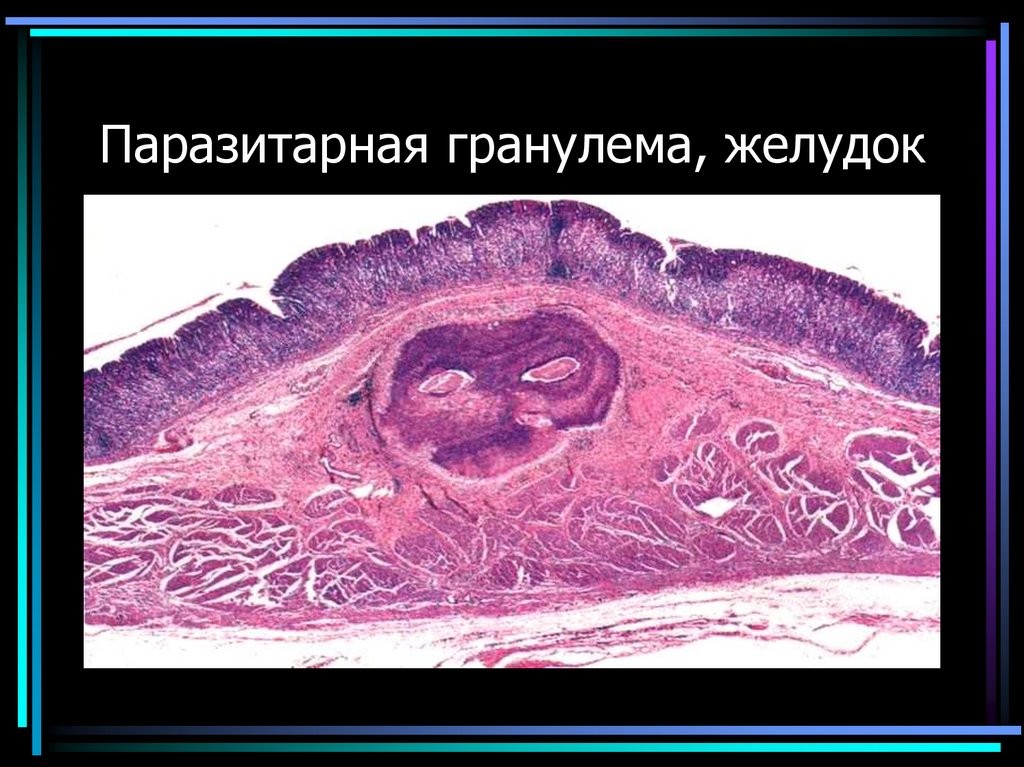 Паразитарная гранулема, желудок