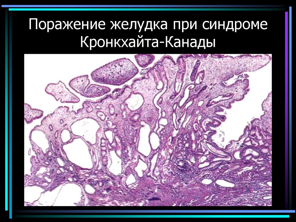 Поражение желудка при синдроме Кронкхайта-Канады