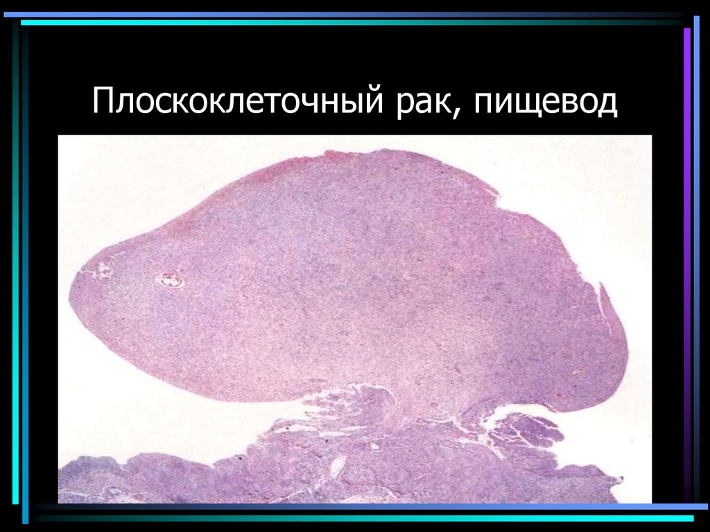 Плоскоклеточный рак, пищевод