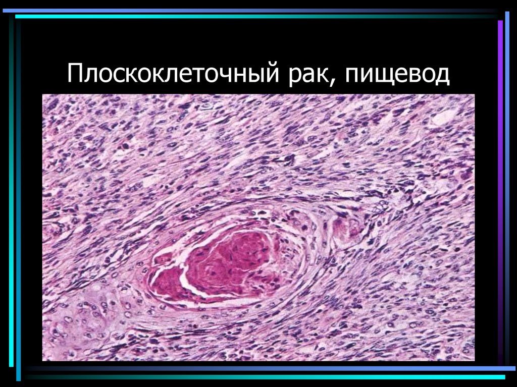 Плоскоклеточный рак, пищевод