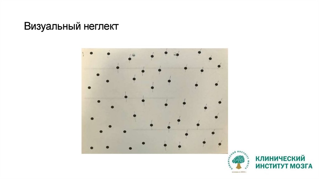 Визуальный неглект