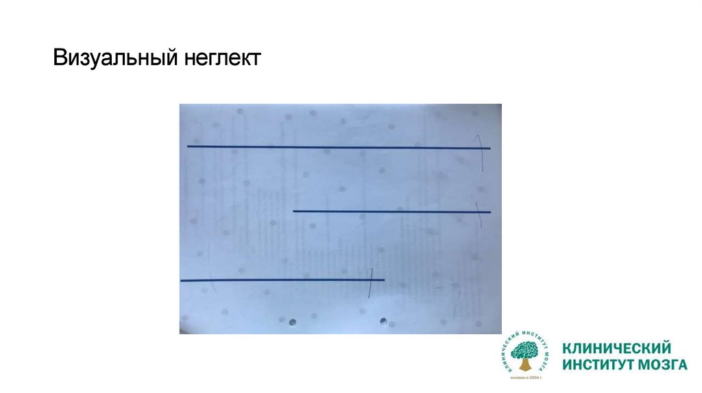 Визуальный неглект