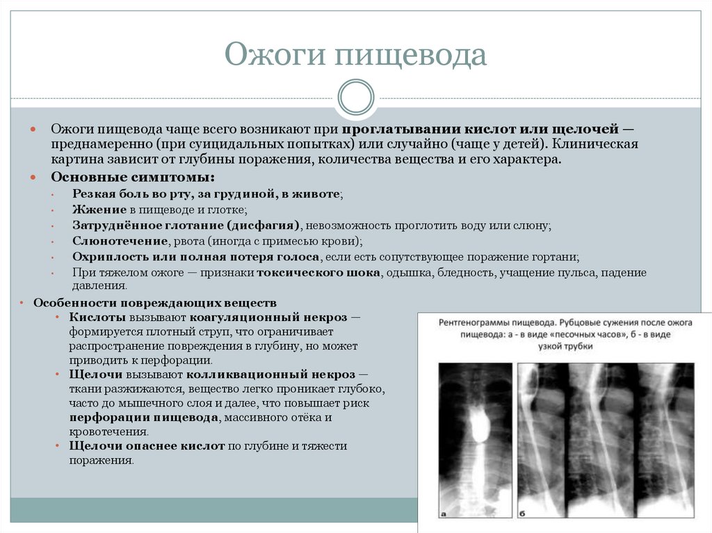 Ожоги пищевода