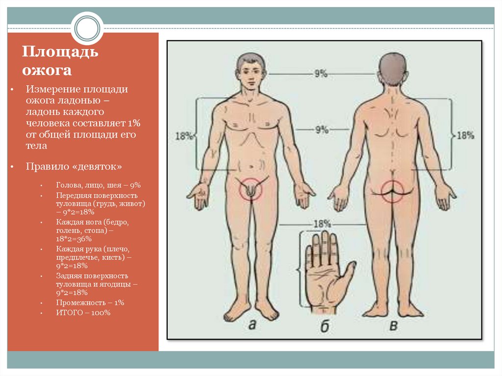 Площадь ожога