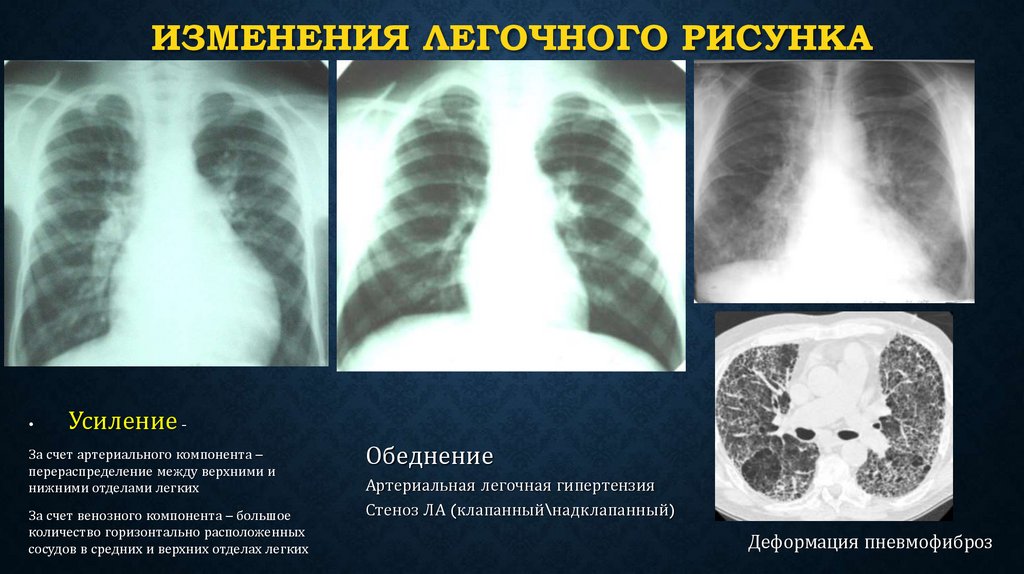 Изменения легочного рисунка
