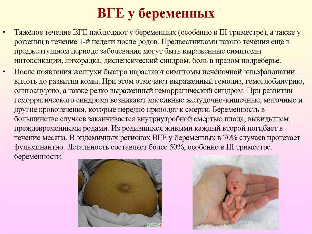 ВГЕ у беременных