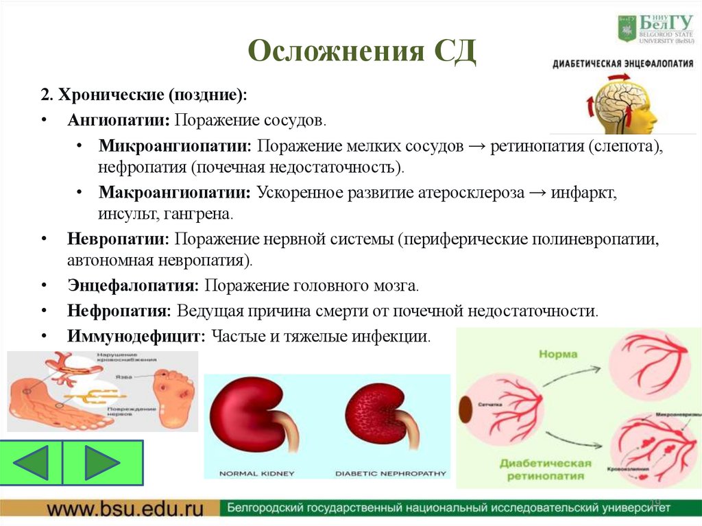 Осложнения СД