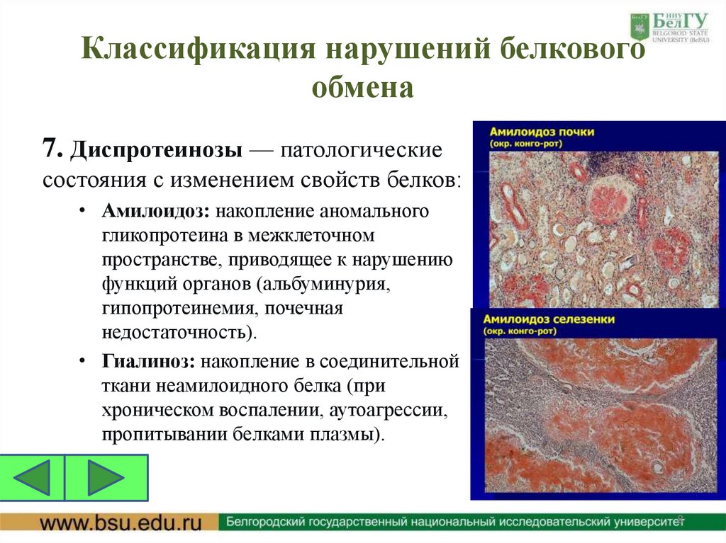 Классификация нарушений белкового обмена