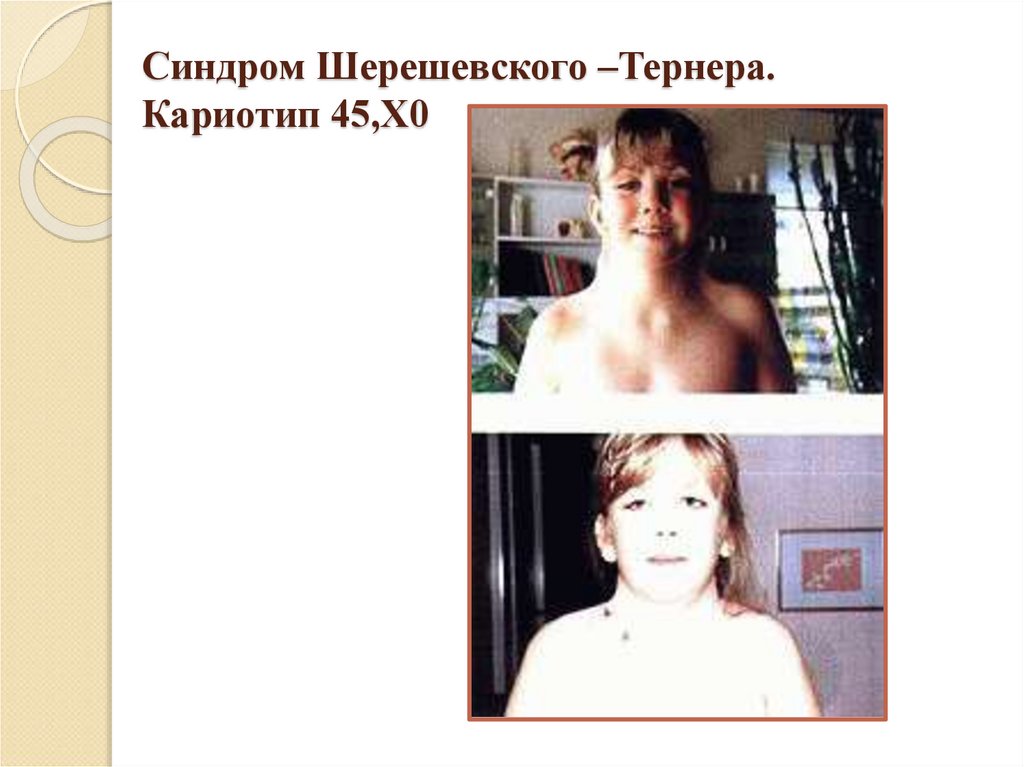 Синдром Шерешевского –Тернера. Кариотип 45,Х0