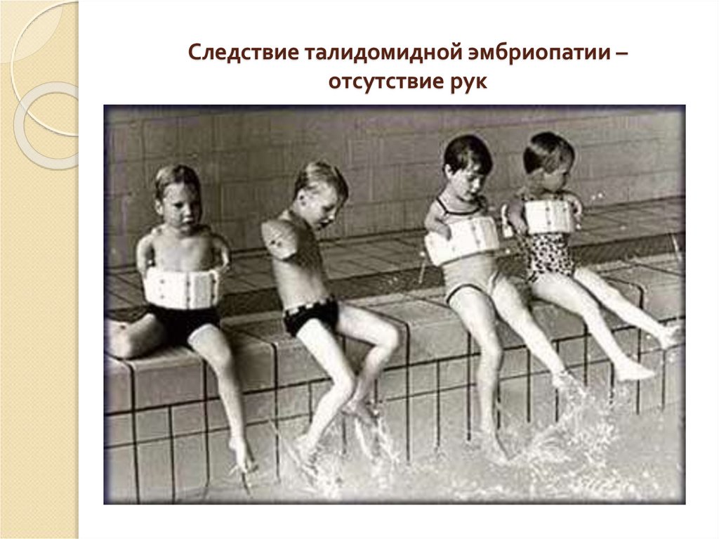 Следствие талидомидной эмбриопатии – отсутствие рук