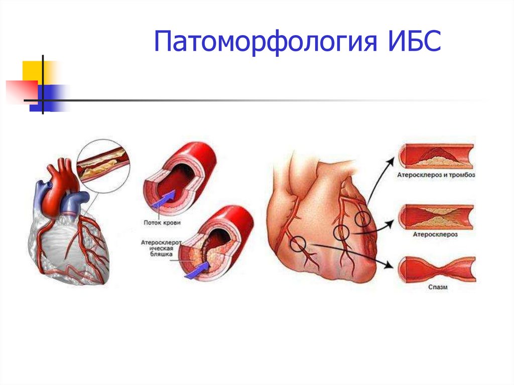 Патоморфология ИБС