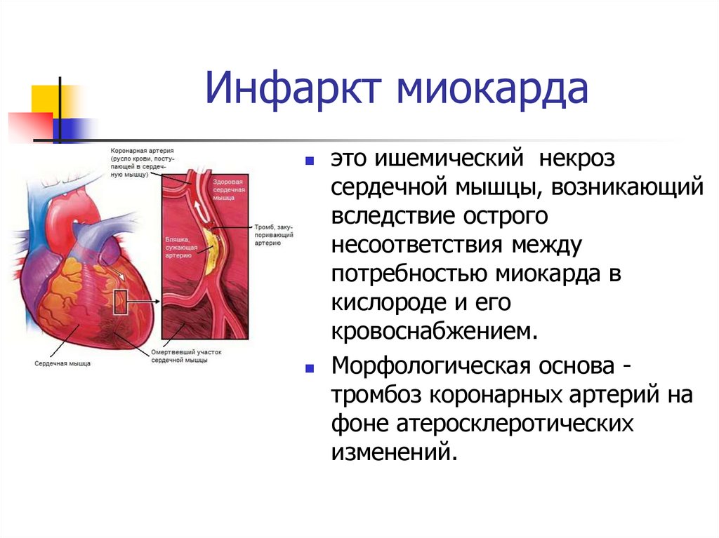 Инфаркт миокарда