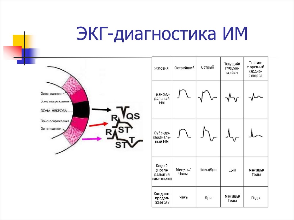ЭКГ-диагностика ИМ