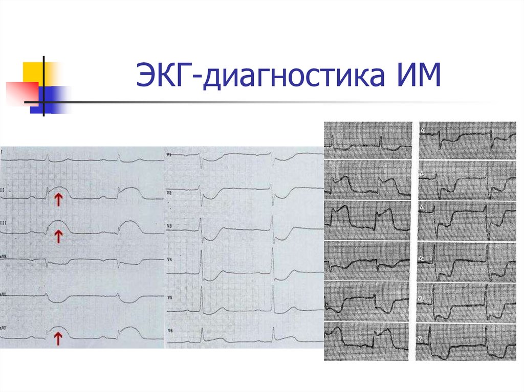 ЭКГ-диагностика ИМ
