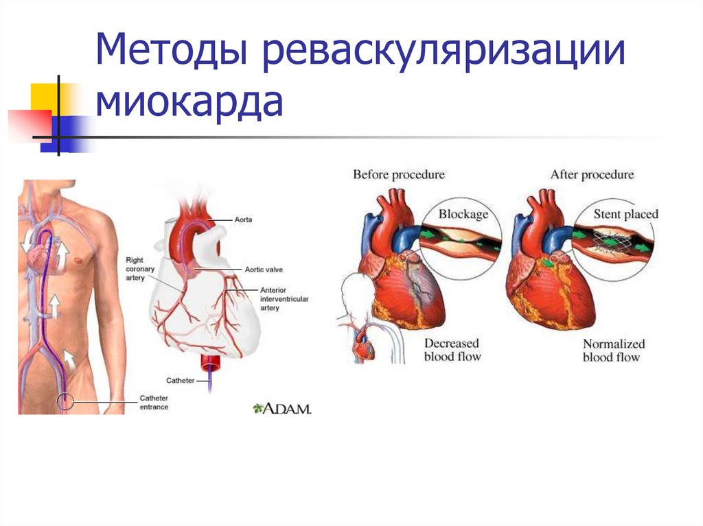 Методы реваскуляризации миокарда