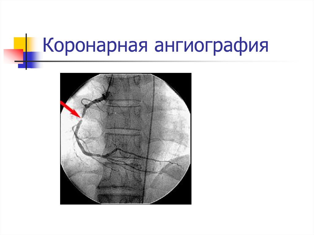 Коронарная ангиография