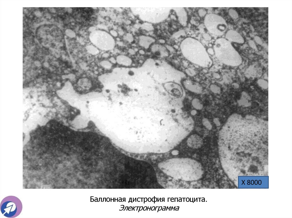 Баллонная дистрофия гепатоцита. Электронограмма