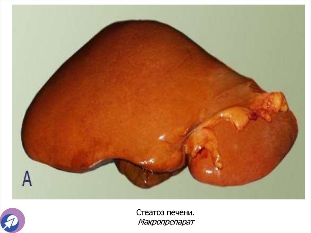 Стеатоз печени. Макропрепарат