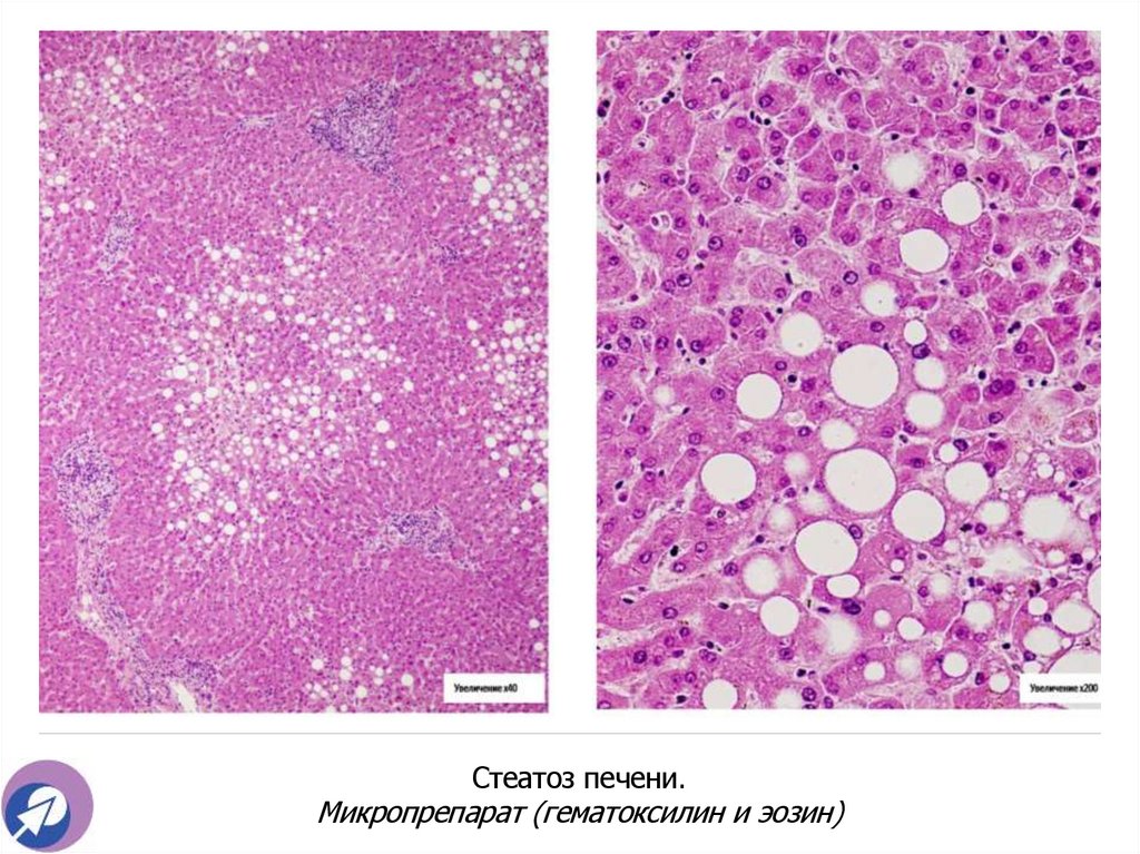 Стеатоз печени. Микропрепарат (гематоксилин и эозин)