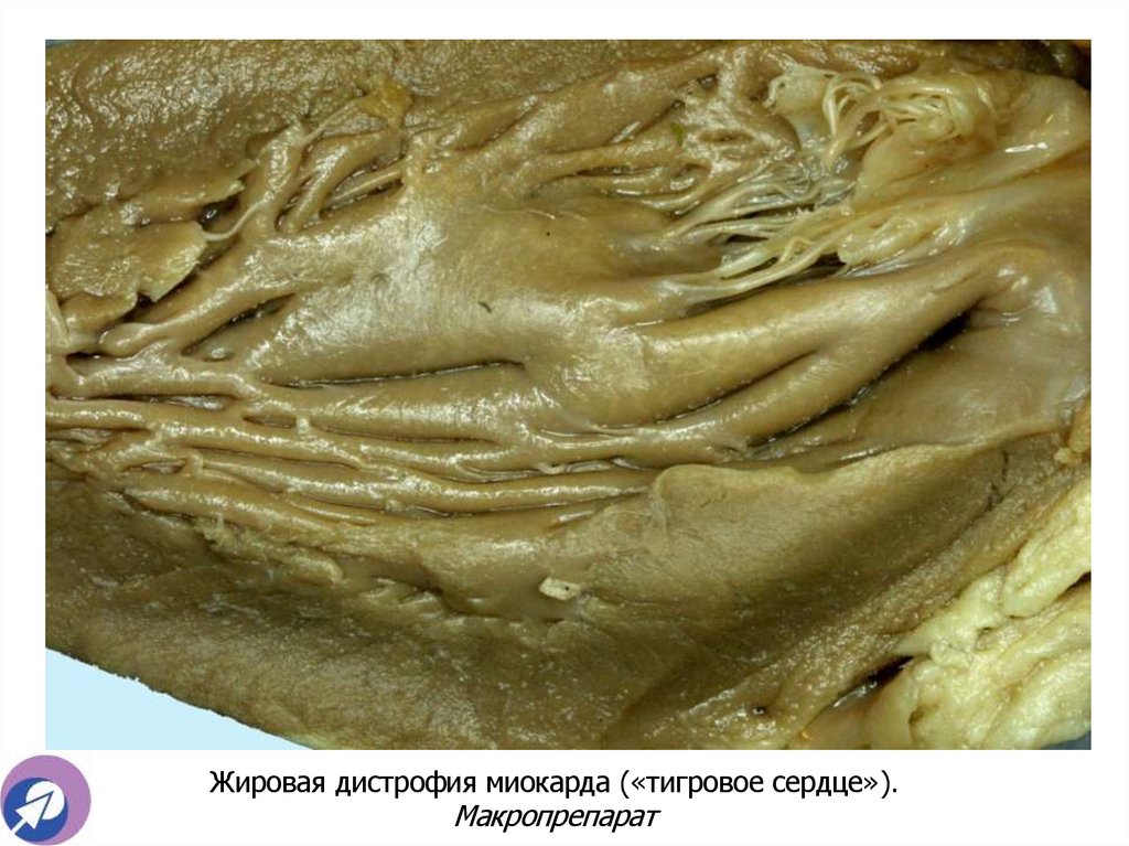 Жировая дистрофия миокарда («тигровое сердце»). Макропрепарат