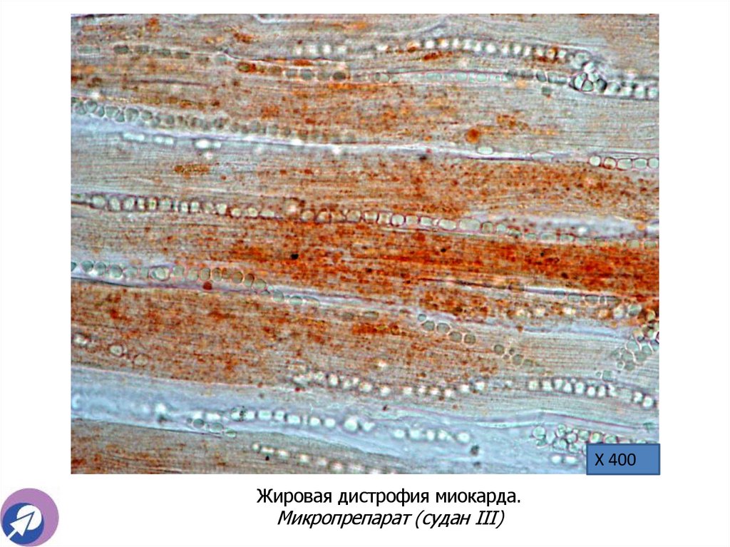 Жировая дистрофия миокарда. Микропрепарат (судан III)
