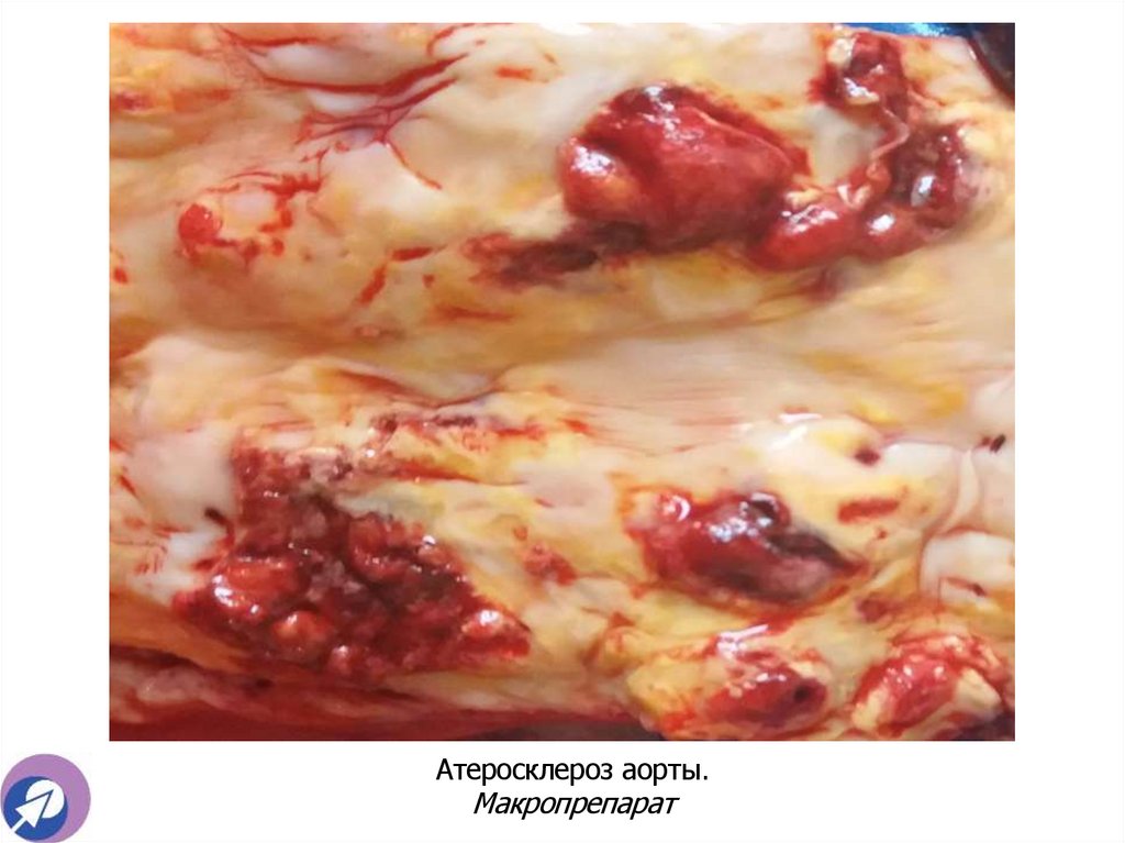 Атеросклероз аорты. Макропрепарат