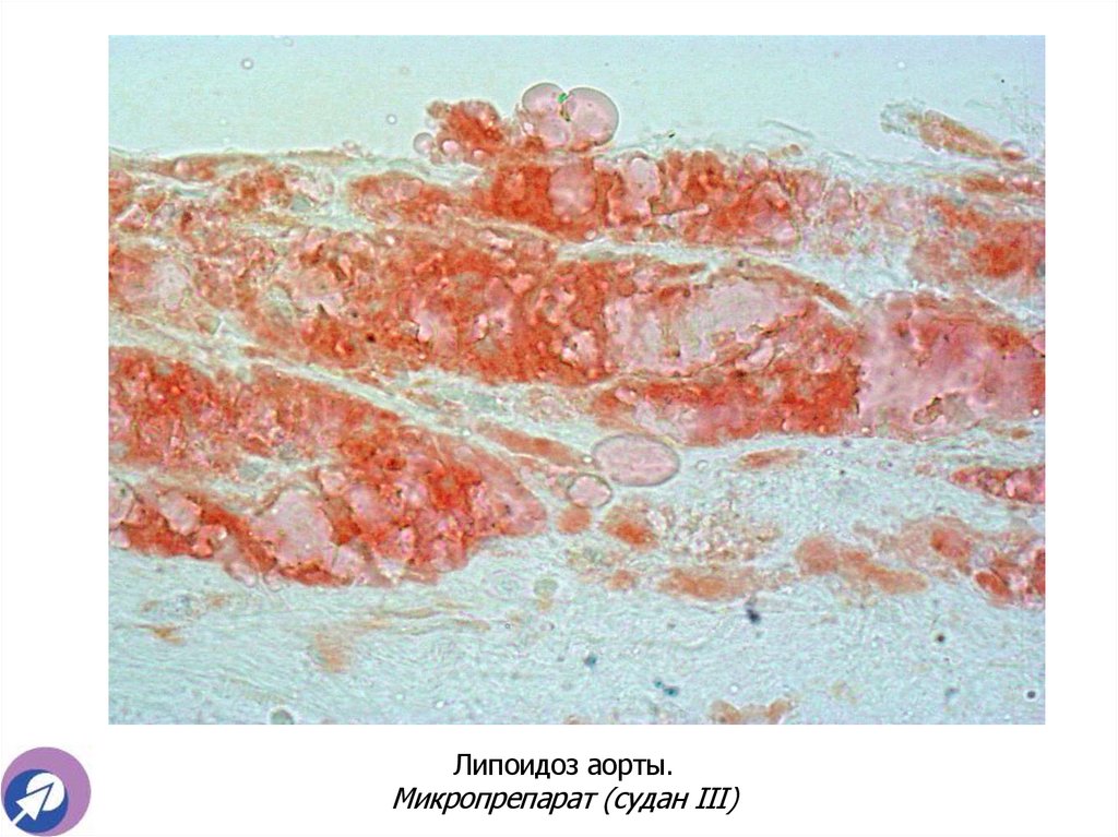 Липоидоз аорты. Микропрепарат (судан III)