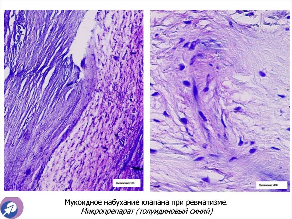 Мукоидное набухание клапана при ревматизме. Микропрепарат (толуидиновый синий)