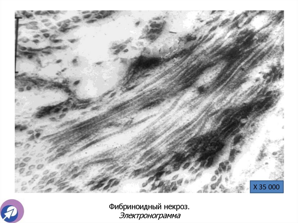 Фибриноидный некроз. Электронограмма