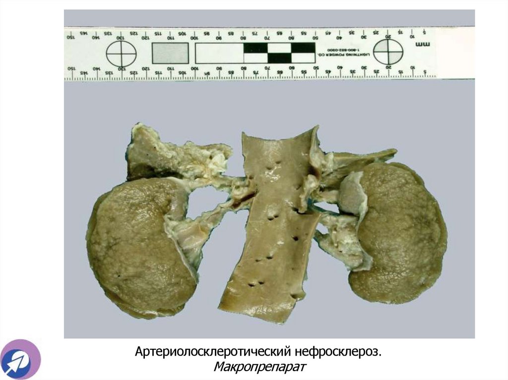 Артериолосклеротический нефросклероз. Макропрепарат