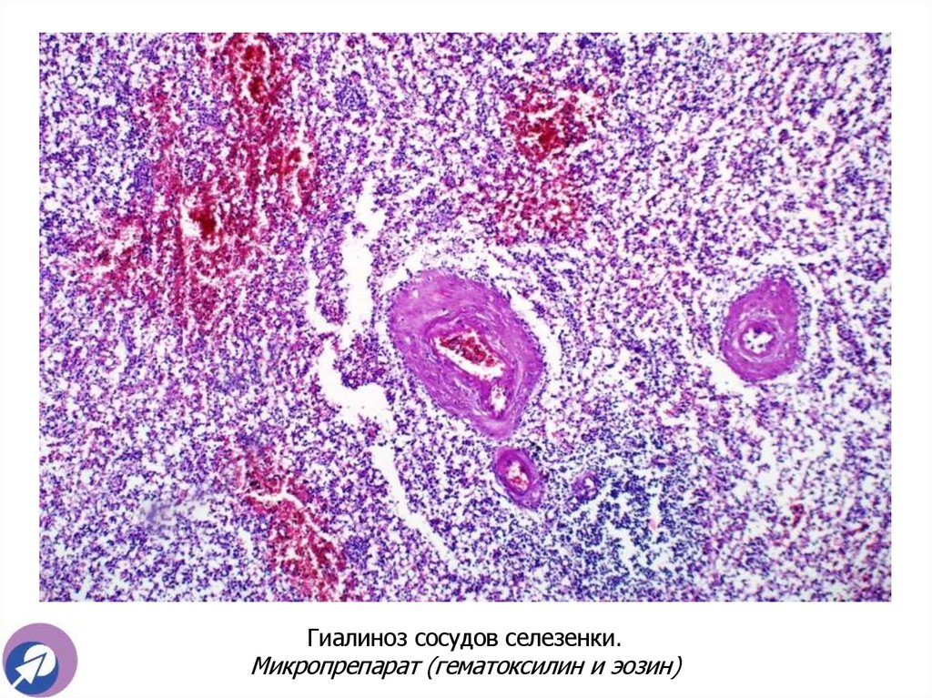 Гиалиноз сосудов селезенки. Микропрепарат (гематоксилин и эозин)