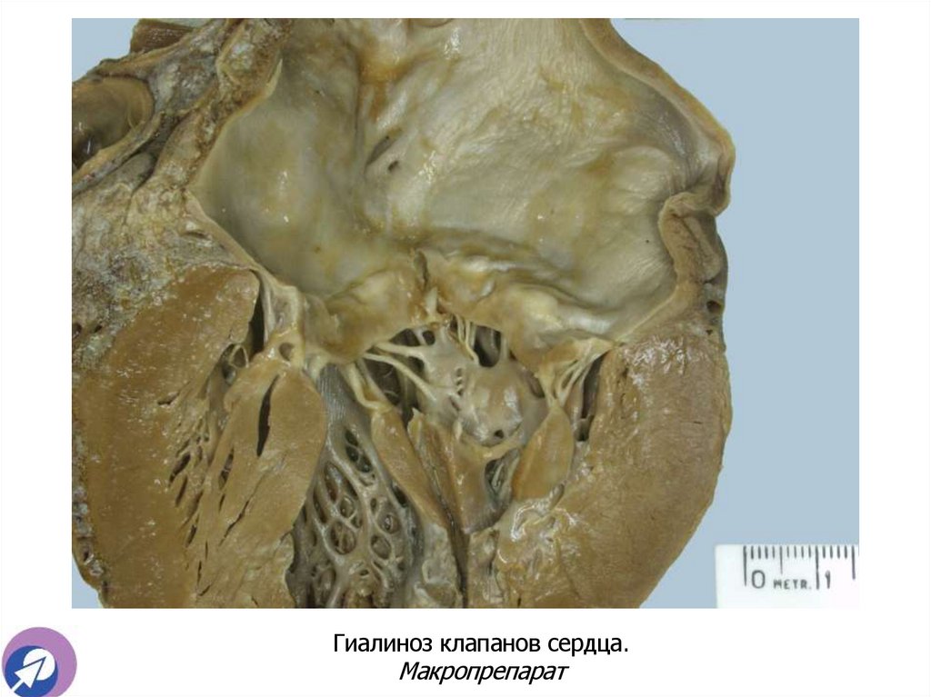 Гиалиноз клапанов сердца. Макропрепарат
