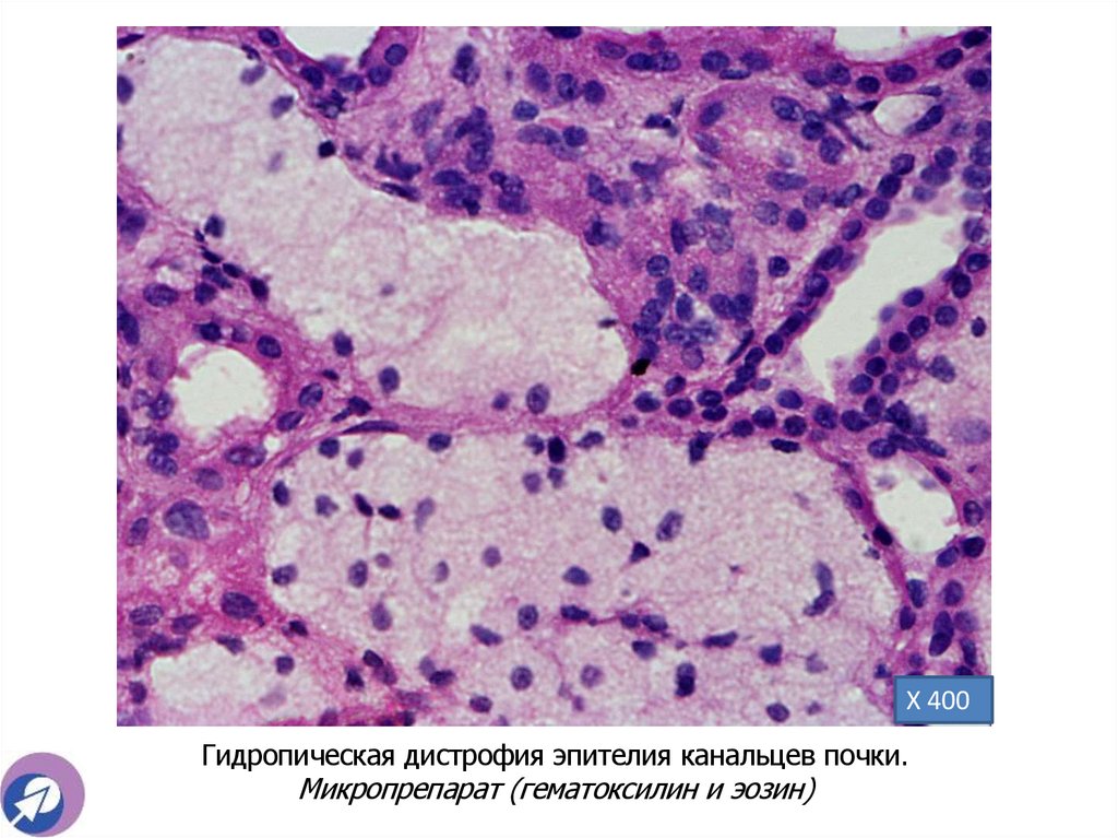 Гидропическая дистрофия эпителия канальцев почки. Микропрепарат (гематоксилин и эозин)