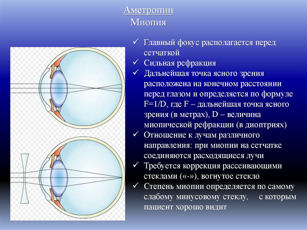 Аметропии Миопия
