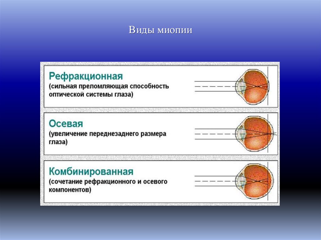 Виды миопии