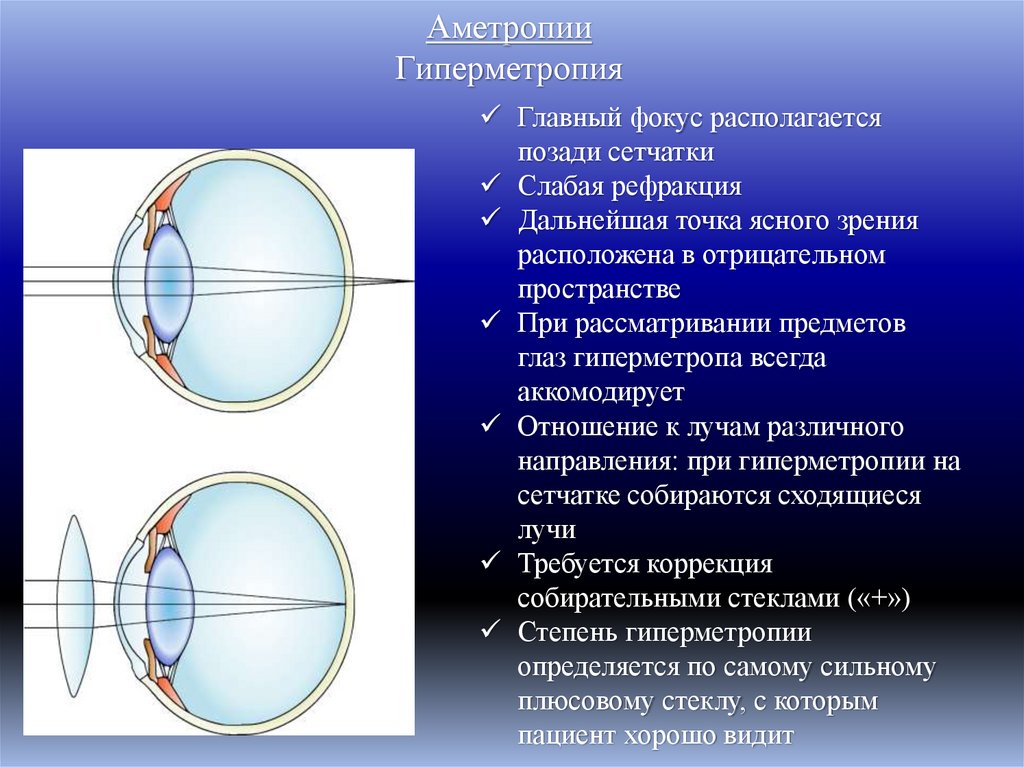 Аметропии Гиперметропия