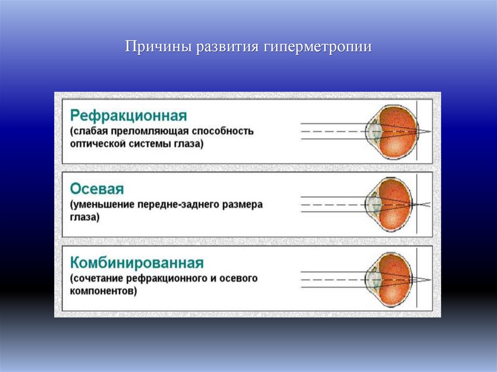 Причины развития гиперметропии