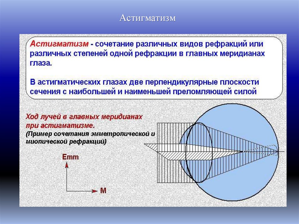 Астигматизм