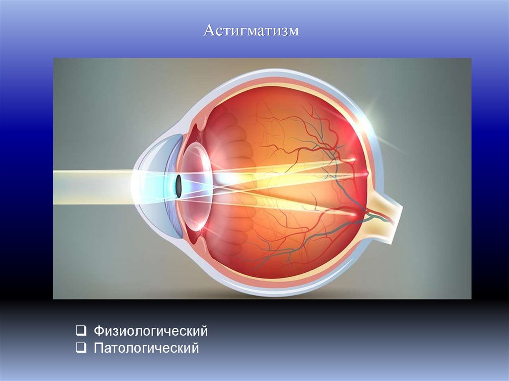 Астигматизм